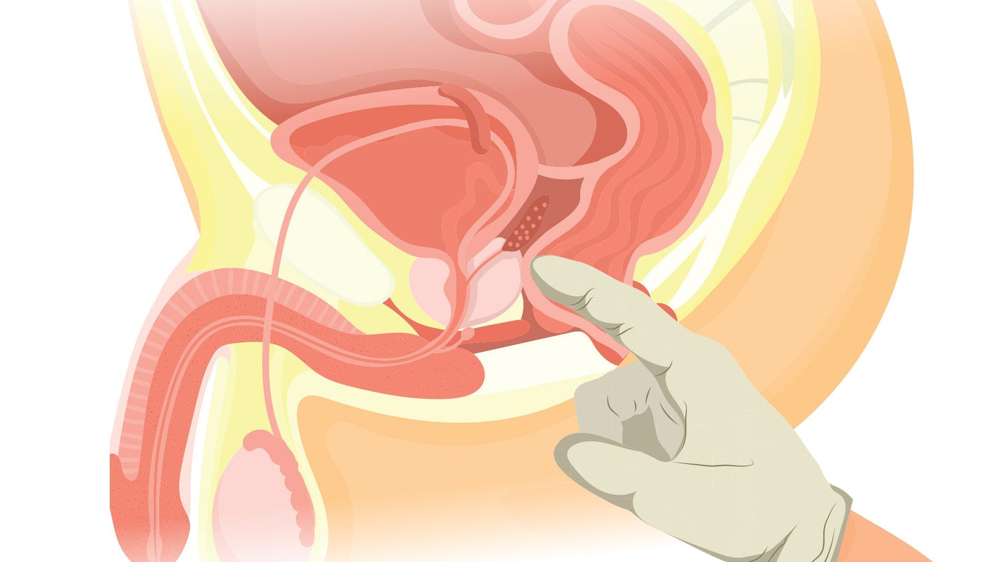 When Should Men Get a Prostate Exam?